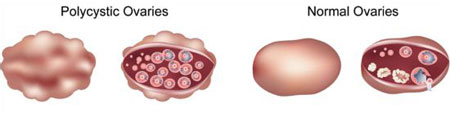 Polycystic Ovaries Diagram