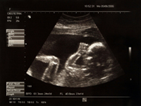 Sonogram of Baby