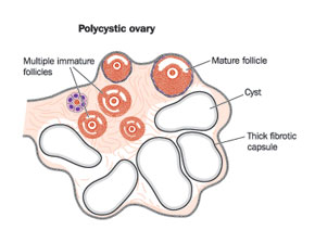 Polycystic Ovary Diagram