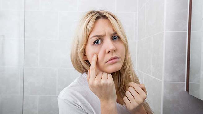 PCOS and Acne: Is DHT causing your breakouts?
